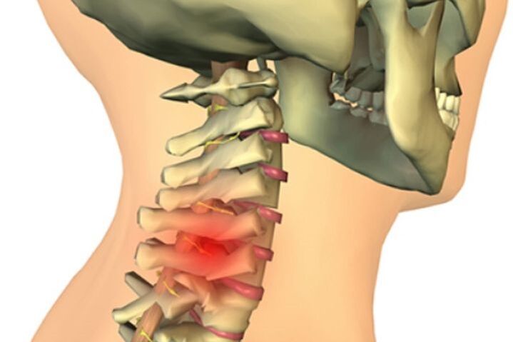 bolečine v vratu zaradi osteoartritisa