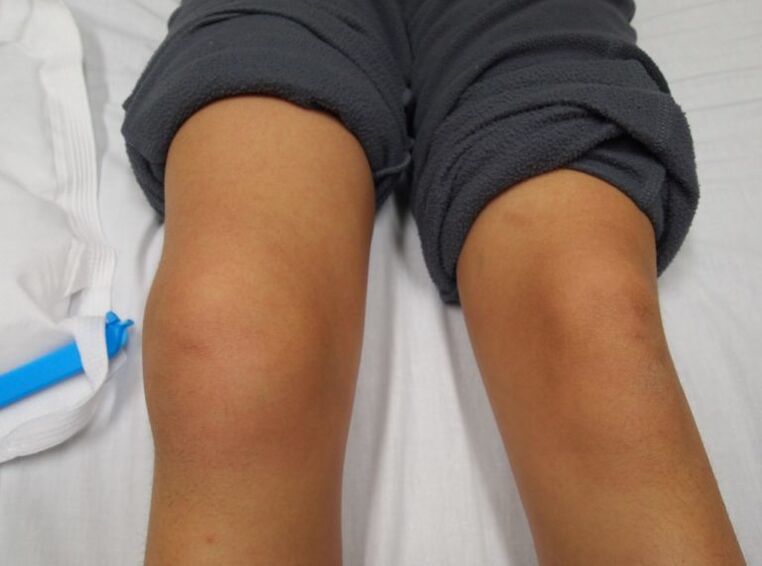 deformacija kolenskega sklepa z artrozo