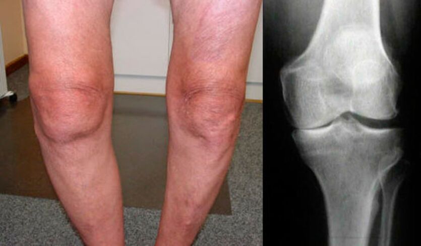 osteoartritis kolenskega sklepa